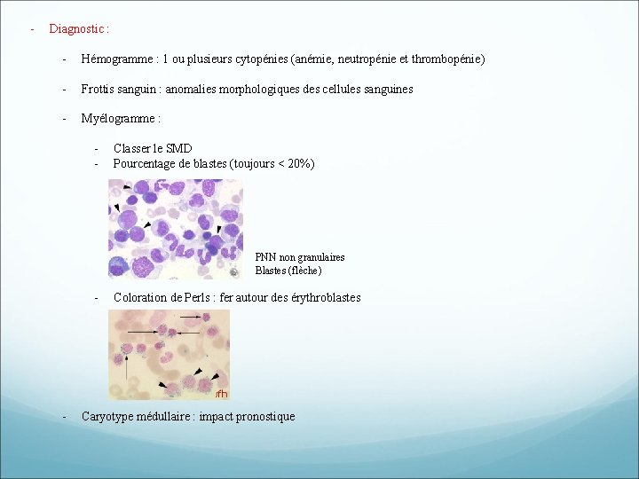 - Diagnostic : - Hémogramme : 1 ou plusieurs cytopénies (anémie, neutropénie et thrombopénie) - Diagnostic : - Hémogramme : 1 ou plusieurs cytopénies (anémie, neutropénie et thrombopénie)