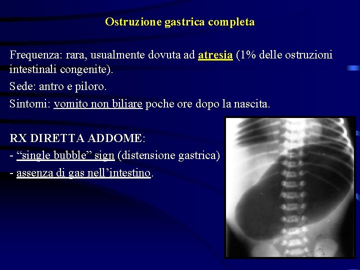 Ostruzione gastrica completa Frequenza: rara, usualmente dovuta ad atresia (1% delle ostruzioni intestinali congenite).