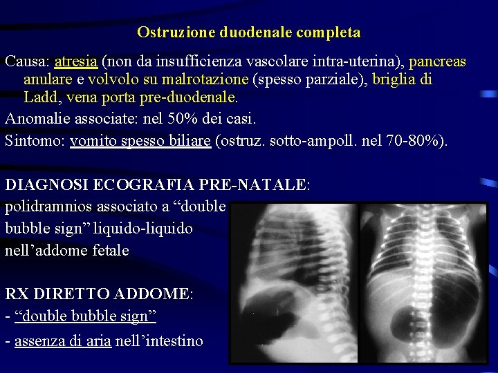 Ostruzione duodenale completa Causa: atresia (non da insufficienza vascolare intra-uterina), pancreas anulare e volvolo