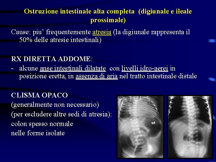 Ostruzione intestinale alta completa (digiunale e ileale prossimale) Cause: piu’ frequentemente atresia (la digiunale