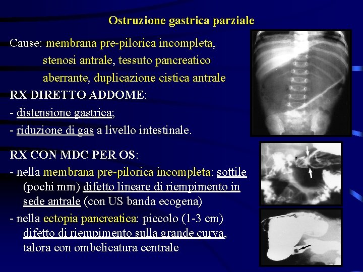 Ostruzione gastrica parziale Cause: membrana pre-pilorica incompleta, stenosi antrale, tessuto pancreatico aberrante, duplicazione cistica