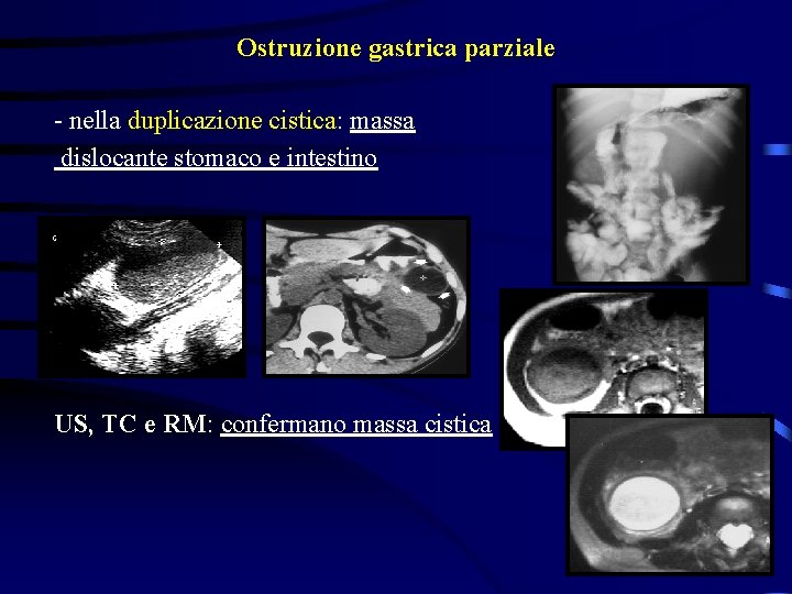 Ostruzione gastrica parziale - nella duplicazione cistica: massa dislocante stomaco e intestino US, TC