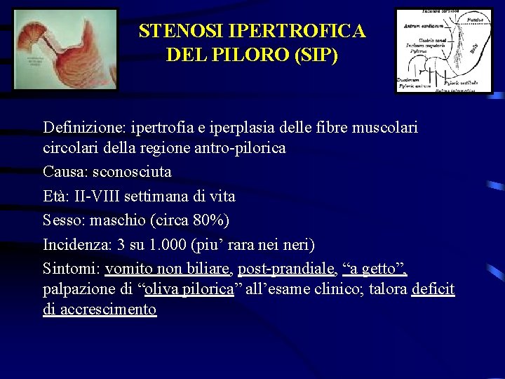 STENOSI IPERTROFICA DEL PILORO (SIP) Definizione: ipertrofia e iperplasia delle fibre muscolari circolari della