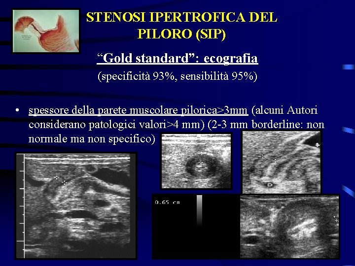 STENOSI IPERTROFICA DEL PILORO (SIP) “Gold standard”: ecografia (specificità 93%, sensibilità 95%) • spessore