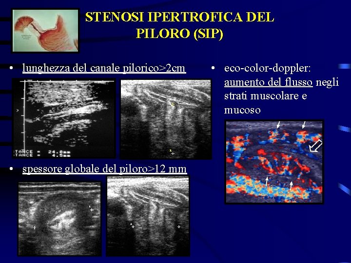 STENOSI IPERTROFICA DEL PILORO (SIP) • lunghezza del canale pilorico>2 cm • spessore globale