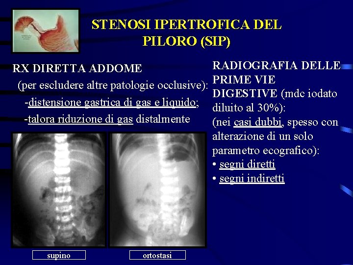 STENOSI IPERTROFICA DEL PILORO (SIP) RX DIRETTA ADDOME (per escludere altre patologie occlusive): -distensione