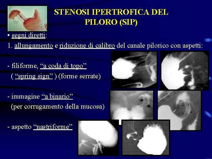 STENOSI IPERTROFICA DEL PILORO (SIP) • segni diretti: 1. allungamento e riduzione di calibro