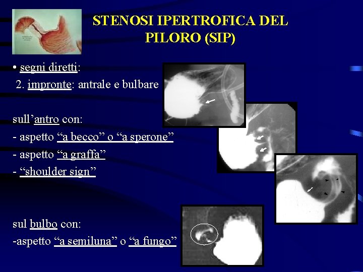 STENOSI IPERTROFICA DEL PILORO (SIP) • segni diretti: 2. impronte: antrale e bulbare sull’antro