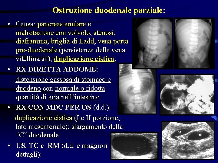 Ostruzione duodenale parziale: • Causa: pancreas anulare e malrotazione con volvolo, stenosi, diaframma, briglia