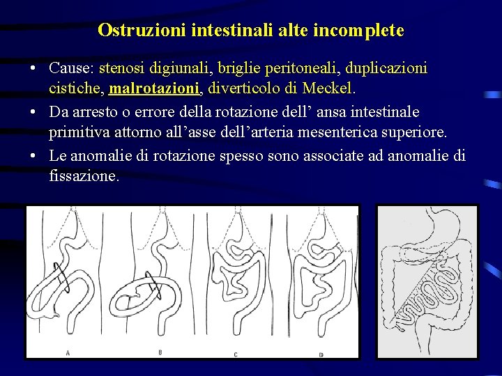 Ostruzioni intestinali alte incomplete • Cause: stenosi digiunali, briglie peritoneali, duplicazioni cistiche, malrotazioni, diverticolo