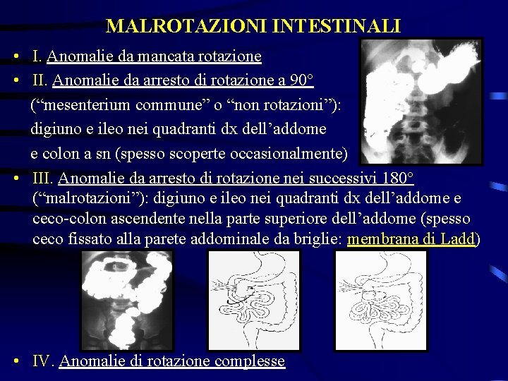 MALROTAZIONI INTESTINALI • I. Anomalie da mancata rotazione • II. Anomalie da arresto di
