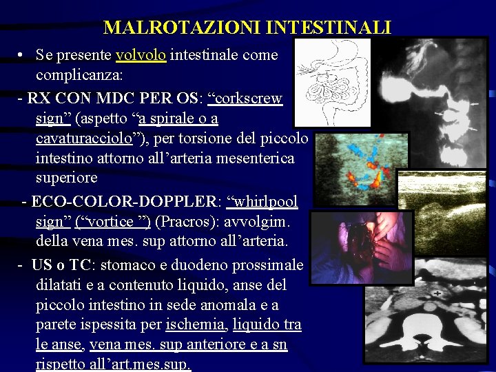 MALROTAZIONI INTESTINALI • Se presente volvolo intestinale complicanza: - RX CON MDC PER OS: