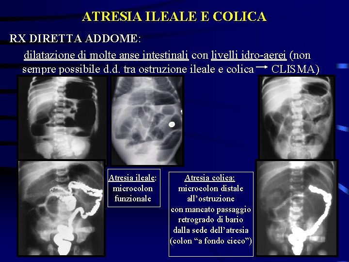 ATRESIA ILEALE E COLICA RX DIRETTA ADDOME: dilatazione di molte anse intestinali con livelli