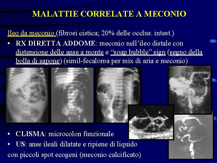 MALATTIE CORRELATE A MECONIO Ileo da meconio (fibrosi cistica; 20% delle occlus. intest. )