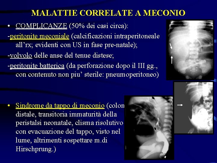 MALATTIE CORRELATE A MECONIO • COMPLICANZE (50% dei casi circa): -peritonite meconiale (calcificazioni intraperitoneale