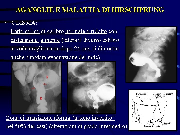 AGANGLIE E MALATTIA DI HIRSCHPRUNG • CLISMA: tratto colico di calibro normale o ridotto