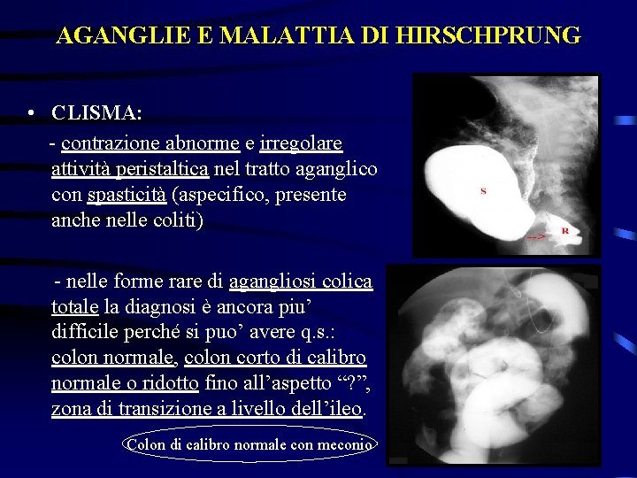 AGANGLIE E MALATTIA DI HIRSCHPRUNG • CLISMA: - contrazione abnorme e irregolare attività peristaltica
