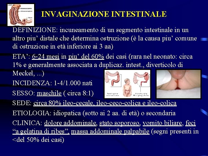 INVAGINAZIONE INTESTINALE DEFINIZIONE: incuneamento di un segmento intestinale in un altro piu’ distale che