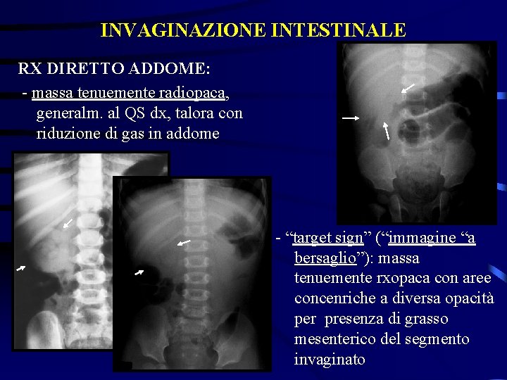 INVAGINAZIONE INTESTINALE RX DIRETTO ADDOME: - massa tenuemente radiopaca, generalm. al QS dx, talora