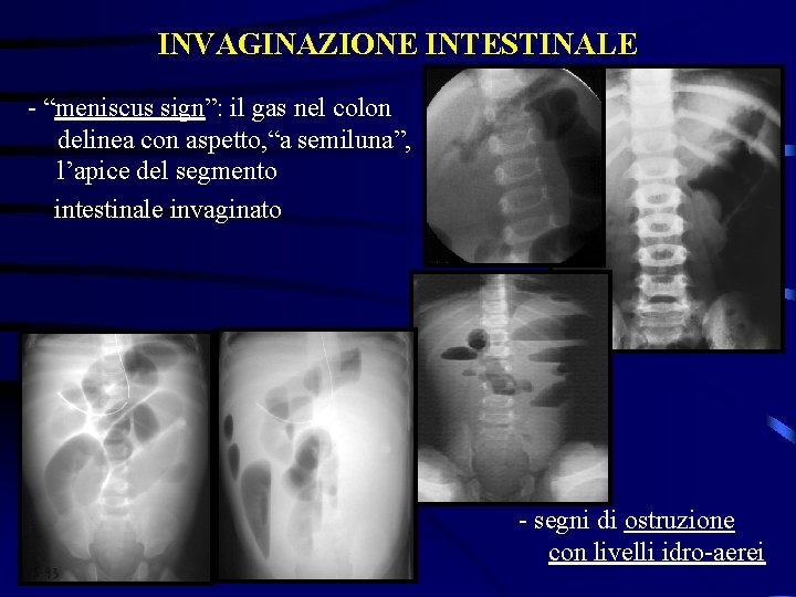 INVAGINAZIONE INTESTINALE - “meniscus sign”: il gas nel colon delinea con aspetto, “a semiluna”,