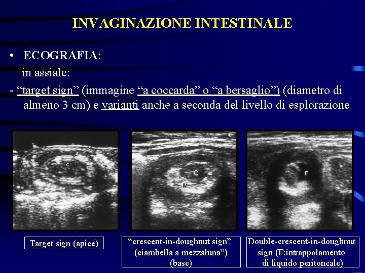 INVAGINAZIONE INTESTINALE • ECOGRAFIA: in assiale: - “target sign” (immagine “a coccarda” o “a