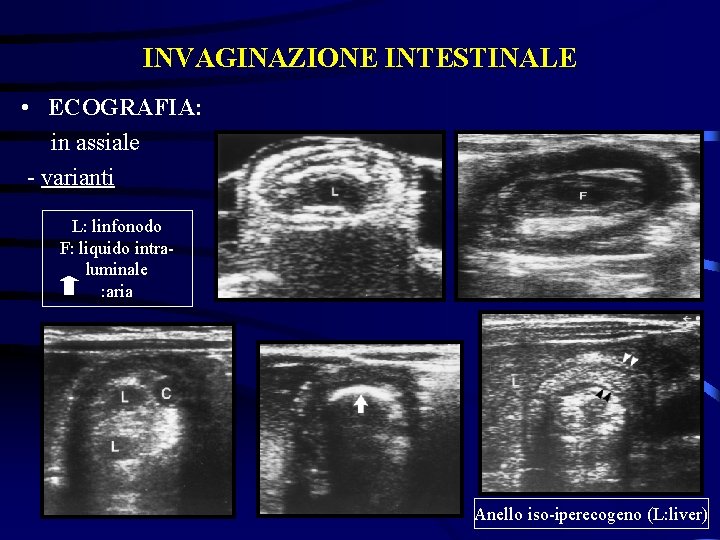 INVAGINAZIONE INTESTINALE • ECOGRAFIA: in assiale - varianti L: linfonodo F: liquido intraluminale :