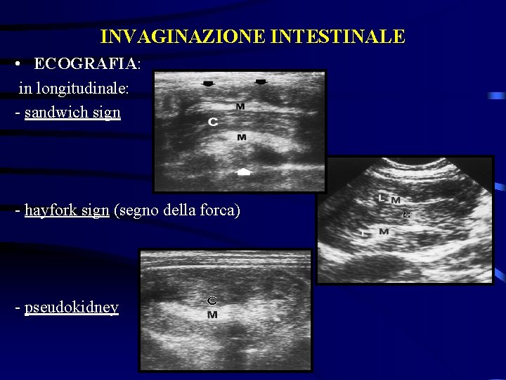 INVAGINAZIONE INTESTINALE • ECOGRAFIA: in longitudinale: - sandwich sign - hayfork sign (segno della