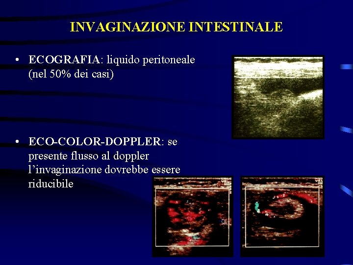 INVAGINAZIONE INTESTINALE • ECOGRAFIA: liquido peritoneale (nel 50% dei casi) • ECO-COLOR-DOPPLER: se presente