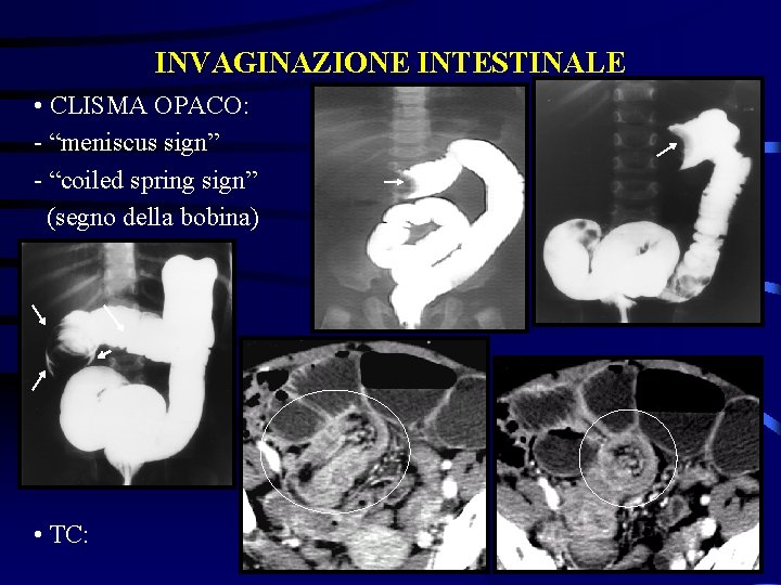 INVAGINAZIONE INTESTINALE • CLISMA OPACO: - “meniscus sign” - “coiled spring sign” (segno della
