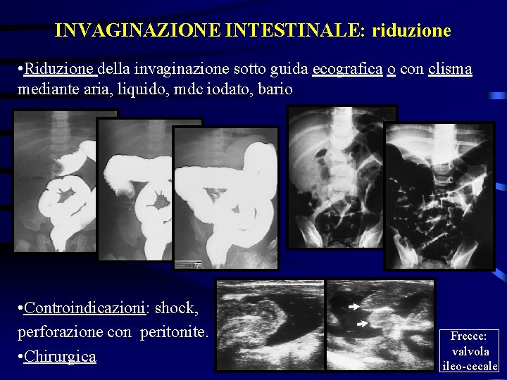 INVAGINAZIONE INTESTINALE: riduzione • Riduzione della invaginazione sotto guida ecografica o con clisma mediante