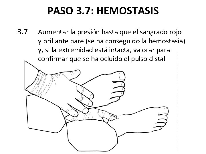 PASO 3. 7: HEMOSTASIS 3. 7 Aumentar la presión hasta que el sangrado rojo