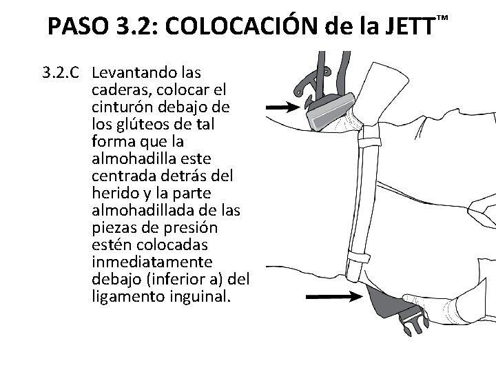 PASO 3. 2: COLOCACIÓN de la JETT™ 3. 2. C Levantando las caderas, colocar