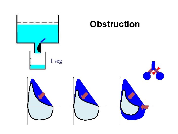 Obstruction 