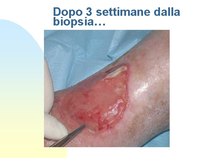 Dopo 3 settimane dalla biopsia… 