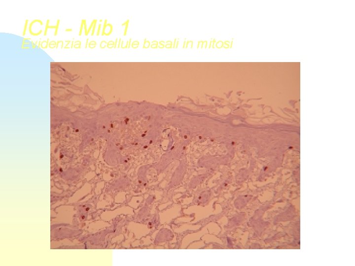 ICH - Mib 1 Evidenzia le cellule basali in mitosi 