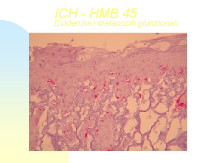 ICH - HMB 45 Evidenzia i melanociti giunzionali 
