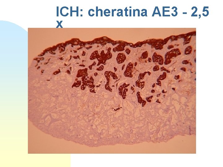 ICH: cheratina AE 3 - 2, 5 x 