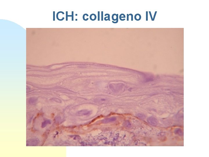 ICH: collageno IV 