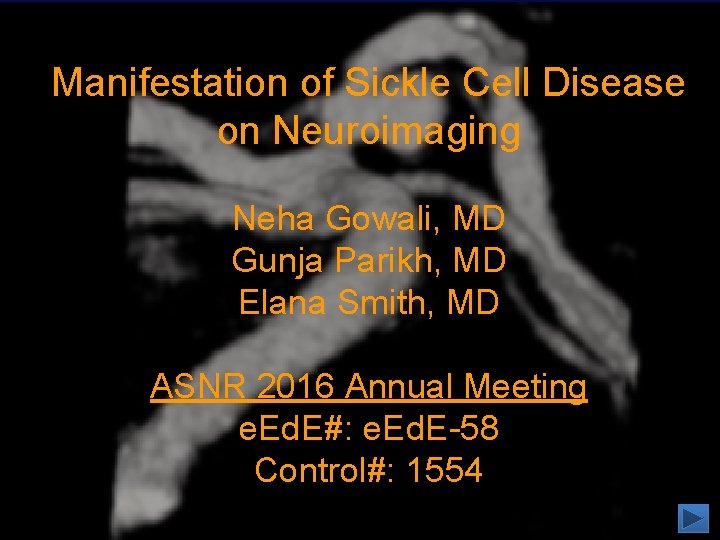 Manifestation of Sickle Cell Disease on Neuroimaging Neha Gowali, MD Gunja Parikh, MD Elana