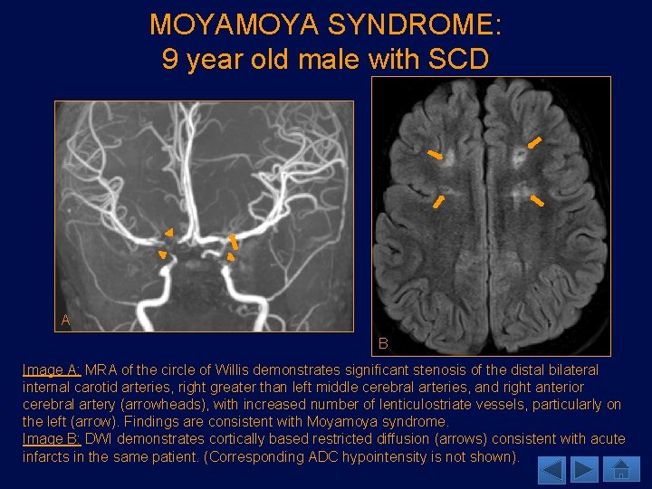 MOYA SYNDROME: 9 year old male with SCD A B Image A: MRA of
