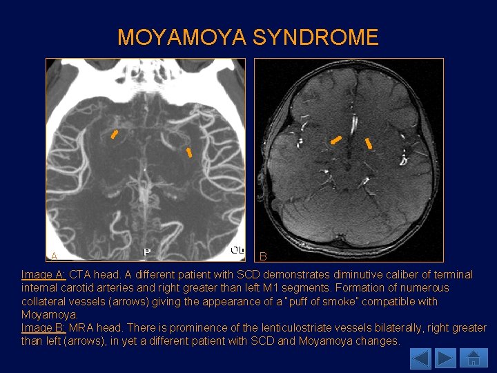 MOYA SYNDROME A B Image A: CTA head. A different patient with SCD demonstrates