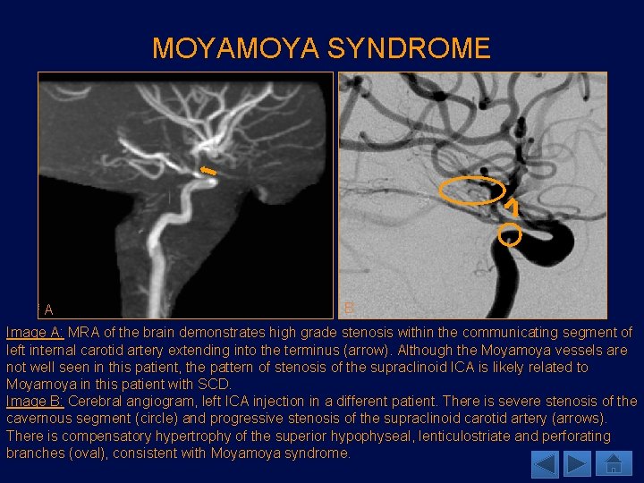 MOYA SYNDROME A B Image A: MRA of the brain demonstrates high grade stenosis