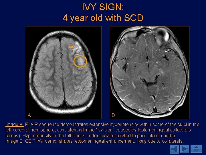 IVY SIGN: 4 year old with SCD A B Image A: FLAIR sequence demonstrates