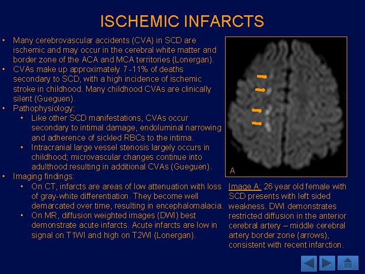 ISCHEMIC INFARCTS • • Many cerebrovascular accidents (CVA) in SCD are ischemic and may