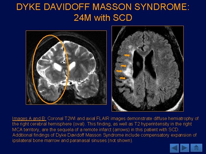 DYKE DAVIDOFF MASSON SYNDROME: 24 M with SCD A B Images A and B: