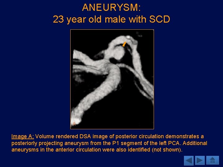 ANEURYSM: 23 year old male with SCD A Image A: Volume rendered DSA image
