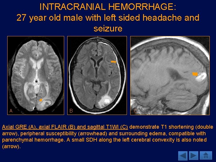 INTRACRANIAL HEMORRHAGE: 27 year old male with left sided headache and seizure A B
