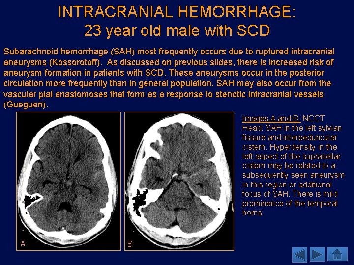 INTRACRANIAL HEMORRHAGE: 23 year old male with SCD Subarachnoid hemorrhage (SAH) most frequently occurs