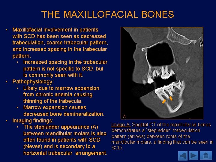 THE MAXILLOFACIAL BONES • Maxillofacial involvement in patients with SCD has been seen as