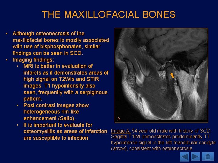 THE MAXILLOFACIAL BONES • Although osteonecrosis of the maxillofacial bones is mostly associated with